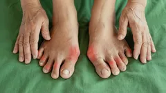 Dolore alle articolazioni delle dita dei piedi? Gli esperti spiegano come eliminarlo per sempre